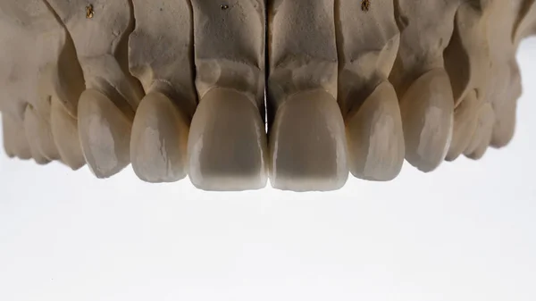 Six Dental Vinir Ceramics Upper Jaw Models White Background — Foto de Stock