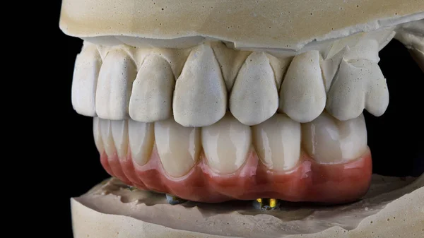 Dental Prosthetic Ceramics with a model made of plaster in bite, side view on a black background