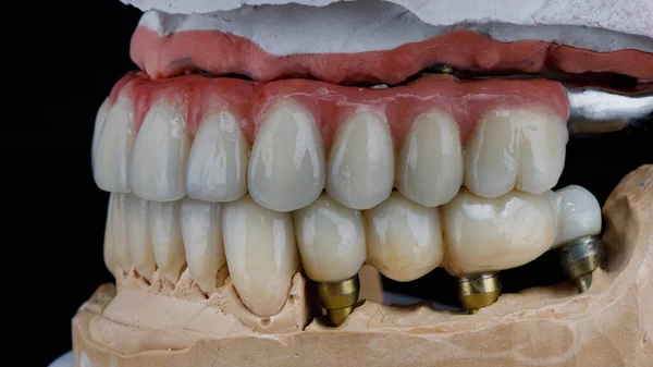 Ceramic Dental Prosthetic Ceramics and Titanium Beams in bite with crowns and bridges