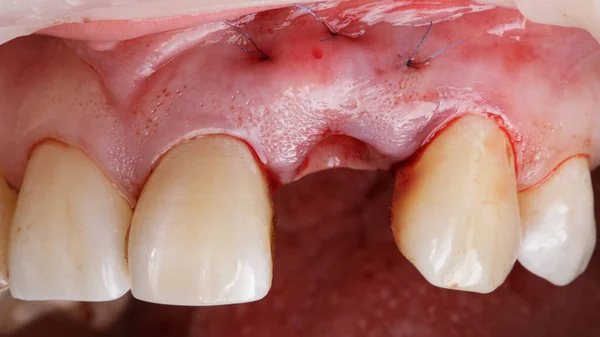 Lack Central Tooth Close Implantation — Fotografia de Stock