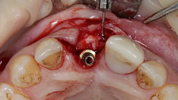 Installed Central Tooth Implant Bone Transplantation — Zdjęcie stockowe