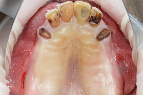 Upper Jaw Teeth Total Dental Implantation View Mirror — Stockfoto