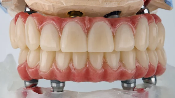 Зубные Протезы Верхней Нижней Челюстей Укусе Белом Фоне Модели — стоковое фото