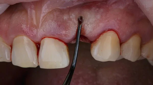 Surgical Instrument Working Gums Implantation Central Tooth — ストック写真