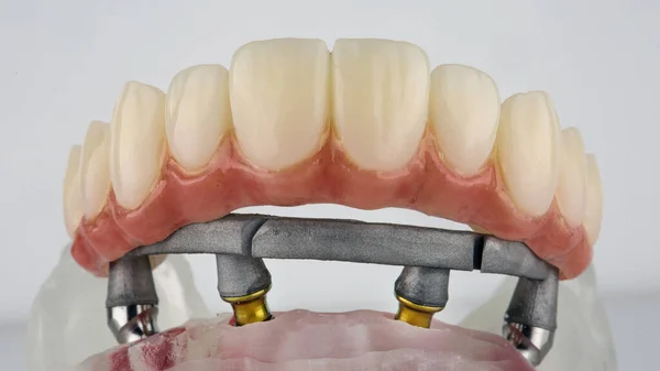 Temporary Dental Prosthesis Upper Jaw Artificial Gum Beam Model — Stock Photo, Image