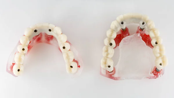 Top View Temporary Dental Prostheses Upper Lower Jaw White Background — Stock Photo, Image