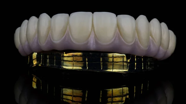 Excellent Angle Dental Prosthesis Upper Jaw Made Zircon Gilded Beam — Stockfoto