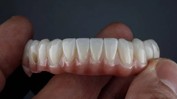 Dental Prosthesis Made Ceramics Titanium Lower Jaw Doctor Hand Black — Zdjęcie stockowe