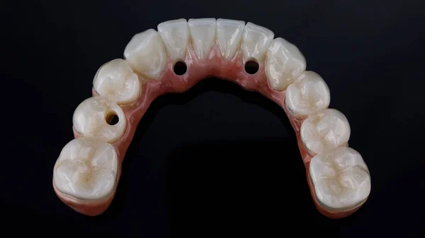 Morphology Dental Prosthesis Made Ceramic Titanium Lower Jaw Top View —  Fotos de Stock