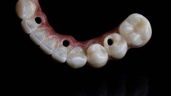 View Chewing Teeth Dental Prosthesis Made Ceramics Lower Jaw Black — ストック写真