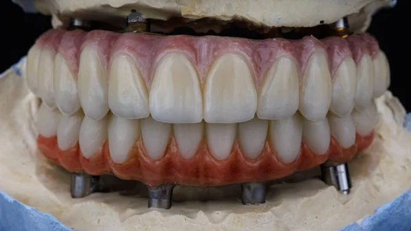 Ideal Composition Dental Prostheses Bite Plaster Models — Fotografia de Stock