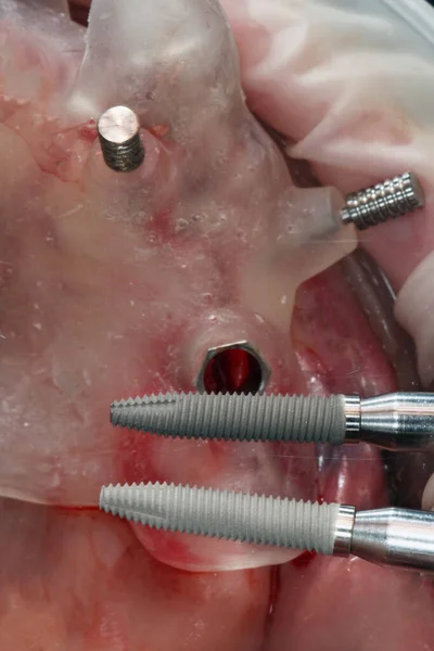 Moment Dental Implantation Template Surgery — Foto Stock