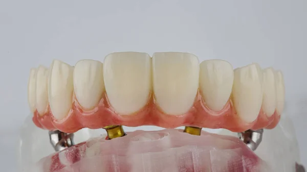 Dental Prosthesis Upper Jaw Gum Beam Special Model White Background —  Fotos de Stock