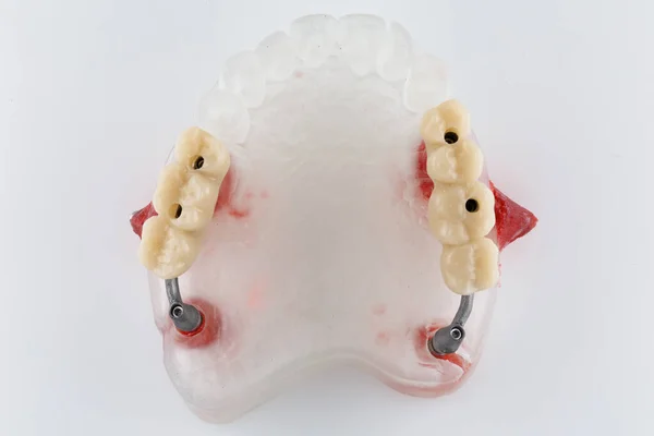 Dental Model Two Bridges Tension Metal Beams Top View Imagen de stock