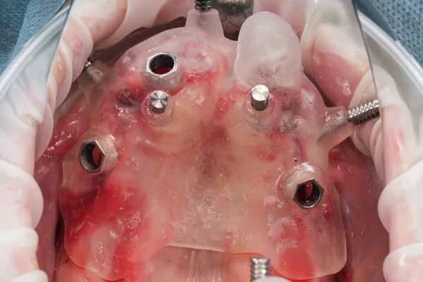 Installed Dental Template Upper Jaw Implantation Imágenes de stock libres de derechos