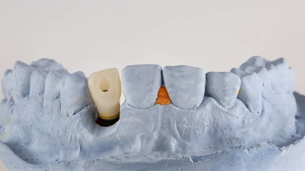 Plaster Model Temporary Dental Crown Second Tooth Fotos de stock libres de derechos