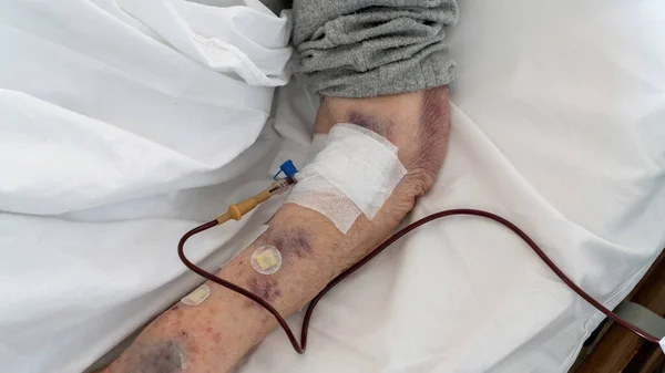 Gamling Som Får Blodtransfusionsserum Sjukhus Medicinskt Koncept — Stockfoto