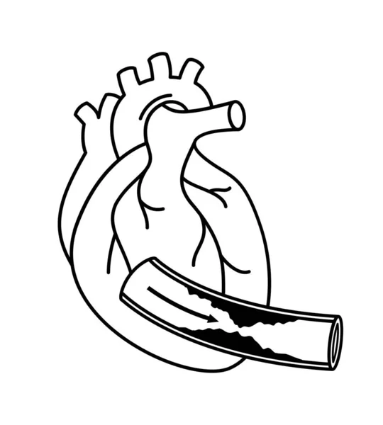 Людське Серце Хворобі Коронарних Артерій Начерк Інформаційної Графіки Заблокована Артерія — стоковий вектор