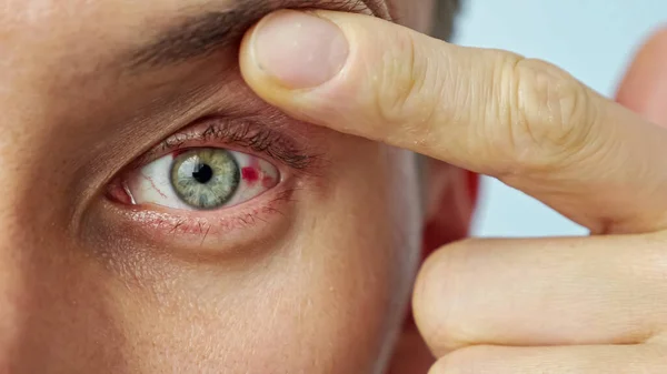 Primer plano de un ojo dolorido del hombre, estirado con los dedos —  Fotos de Stock