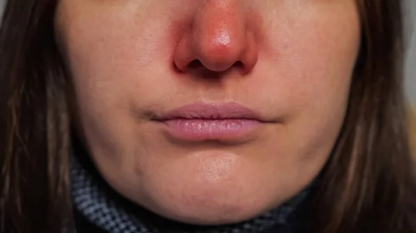 Женщина с покрасневшим носом от болезни сопли в салфетке макро — стоковое фото