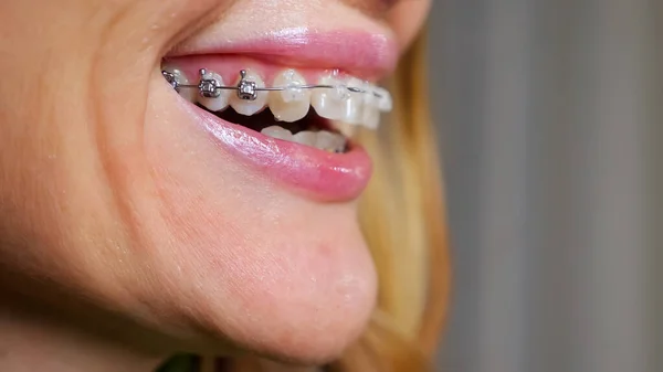 Žena se zubními rovnátky na zubech rozhovory s úsměvem detailní záběr — Stock fotografie
