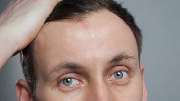Fiatal férfi, kopasz foltok szenvednek hajhullás, — Stock videók