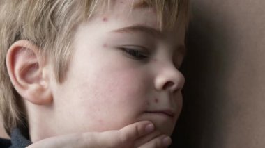 Çocuk Yüzü Kaşındıran Kaşıntılar 'la kaplıydı. Kabarcıklar. Suçiçeği Hastalıklı Çocuk. Çocuk Hastalığı. 2x Yavaş çekim 60 fps 4K