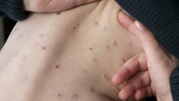 Close Kid Back Rash Itchy Inflamed Blisters Chickenpox Infected Boy — Stock Video