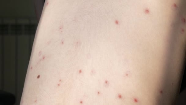 Close Kid Back Rash Itchy Inflamed Blisters Chickenpox Infected Boy — Stock Video