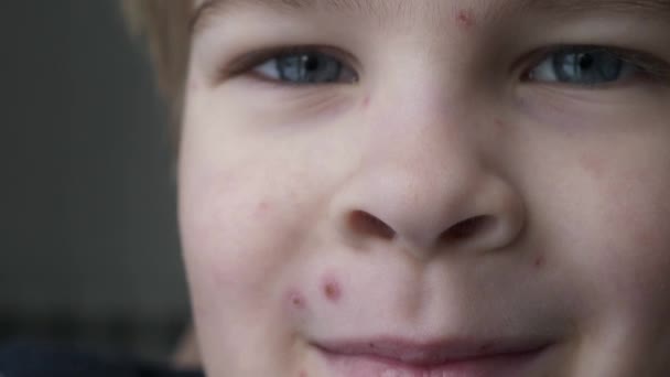 Close Kid Face Covered Rash Itchy Inflamed Blisters Chickenpox Infected — Stockvideo