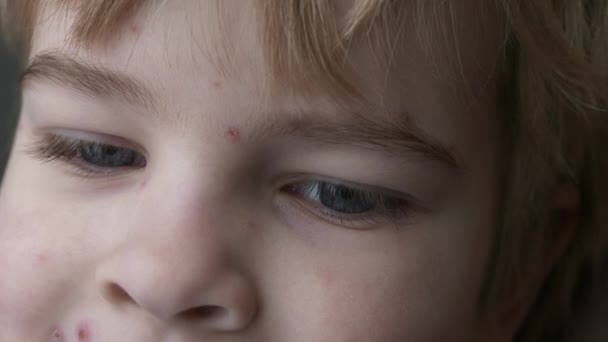 Çocuk Yüzü Kaşındıran Kaşıntılar Kaplıydı Kabarcıklar Suçiçeği Hastalıklı Çocuk Çocuk — Stok video