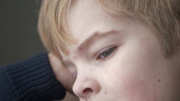 特写小子的脸覆盖了痒发泡的鞭子 水痘感染男孩 儿童疾病 2X慢动作60 Fps — 图库视频影像