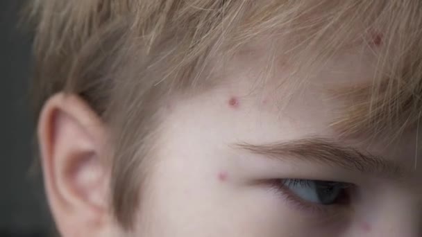 Close Kid Face Covered Rash Itchy Inflamed Blisters Dalam Bahasa — Stok Video