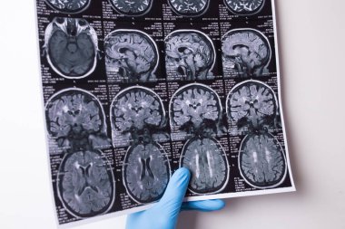 Beyaz bir arkaplanda MRI görüntüsü. Eldivenli doktorlar bir enstantane tutuyor.