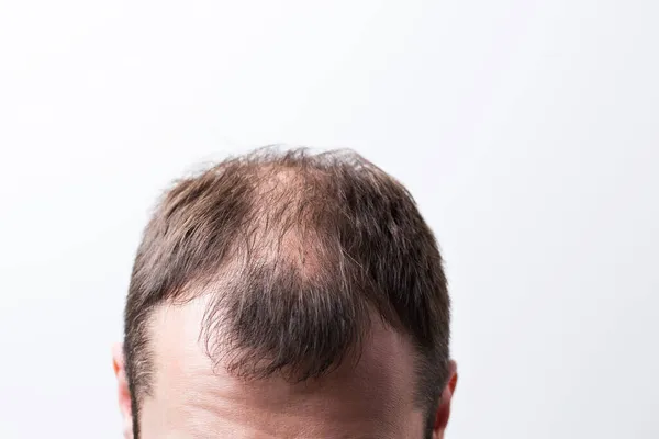 Close-up careca cabeça de um jovem sobre um fundo isolado branco — Fotografia de Stock