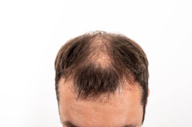 Beyaz izole edilmiş arka planda genç bir adamın kelleşen kafası..