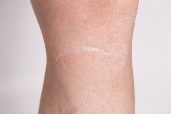 Scar on a girls leg close-up. Varicose veins from the injury on the leg on a white isolated background.