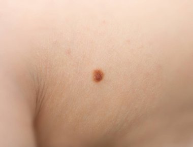 Deri benini kapatın. Melanom, kahverengi nevus, küçük doğum lekesi, insan derisinde lekeye benzer lekeler.