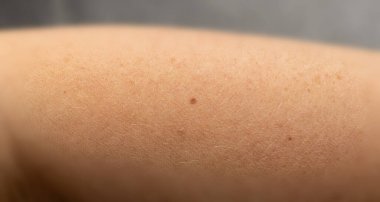 Deri benini kapatın. Melanom, kahverengi nevus, küçük doğum lekesi, insan derisinde lekeye benzer lekeler.