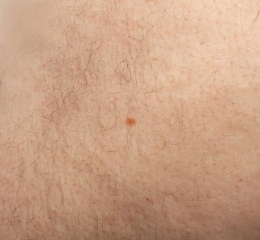 Deri benini kapatın. Melanom, kahverengi nevus, küçük doğum lekesi, kıllı insan derisinde lekeye benzer lekeler.