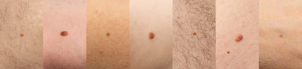 Different Types Skin Mole Closeup Macro Photo Blemish Classes Brown — Stock Photo, Image