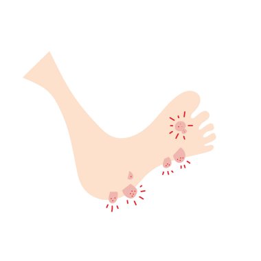 Plantar wart icon. Verruca symbol, foot corn, human papillomavirus sign, HPV infection, clavus pictogram, feet papilloma vector illustration clipart
