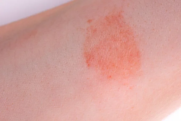 Cildindeki büyük kırmızı nokta.