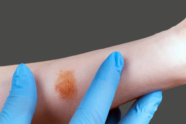 Dokter Menghabiskan Pemeriksaan Ruam Alergi Pasien — Stok Foto