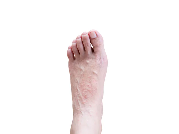 An itchy skin rash on woman's foot caused by allergic eczema isolated on white background. Health and skin problems. Clipping path.