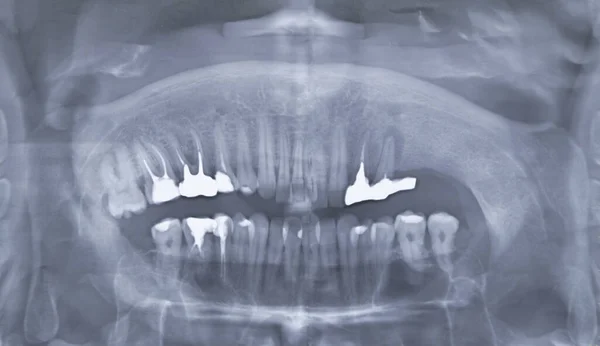 歯のX線画像 歯のスキャン — ストック写真