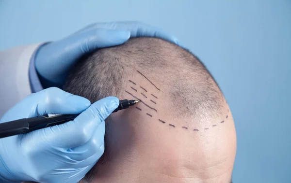 Patient Suffering Hair Loss Consultation Doctor Doctor Using Skin Marker — Stock Photo, Image
