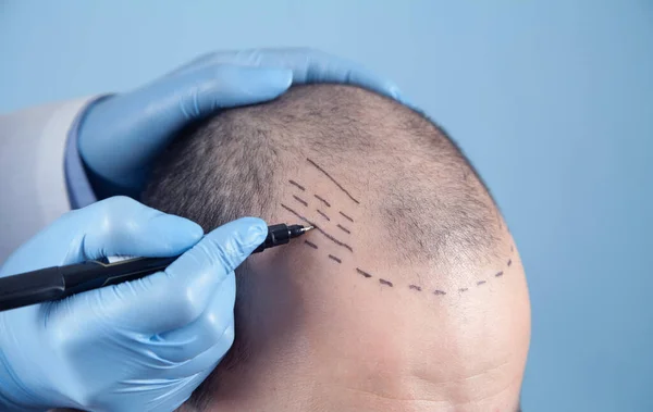 Patient suffering from hair loss in consultation with a doctor. Doctor using skin marker