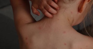 Girl itches, skin rashes. Five-year-old girl with chickenpox, measles, Monkeypox virus.