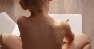 five-year-old girl with chickenpox, measles, Monkeypox virus. Sick child with chickenpox.